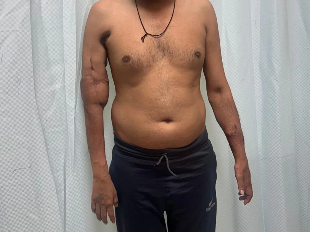 Reconstructive outcome after surgery in Surat