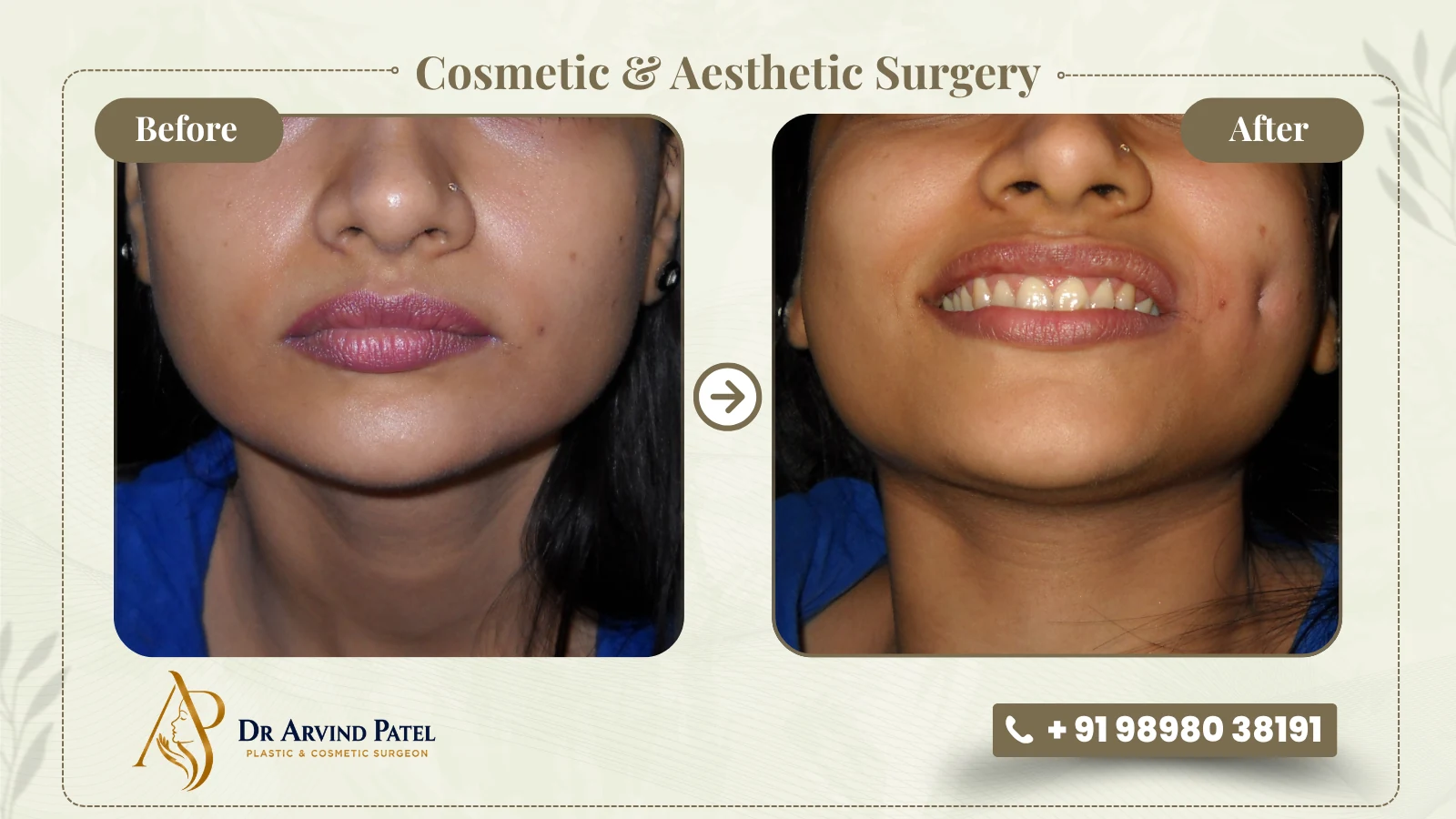 Cosmetic and aesthetic surgery, before and after