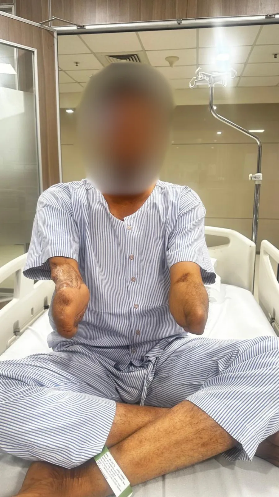 A bilateral upper-limb amputee on the ward at Kiran Hospital, Surat