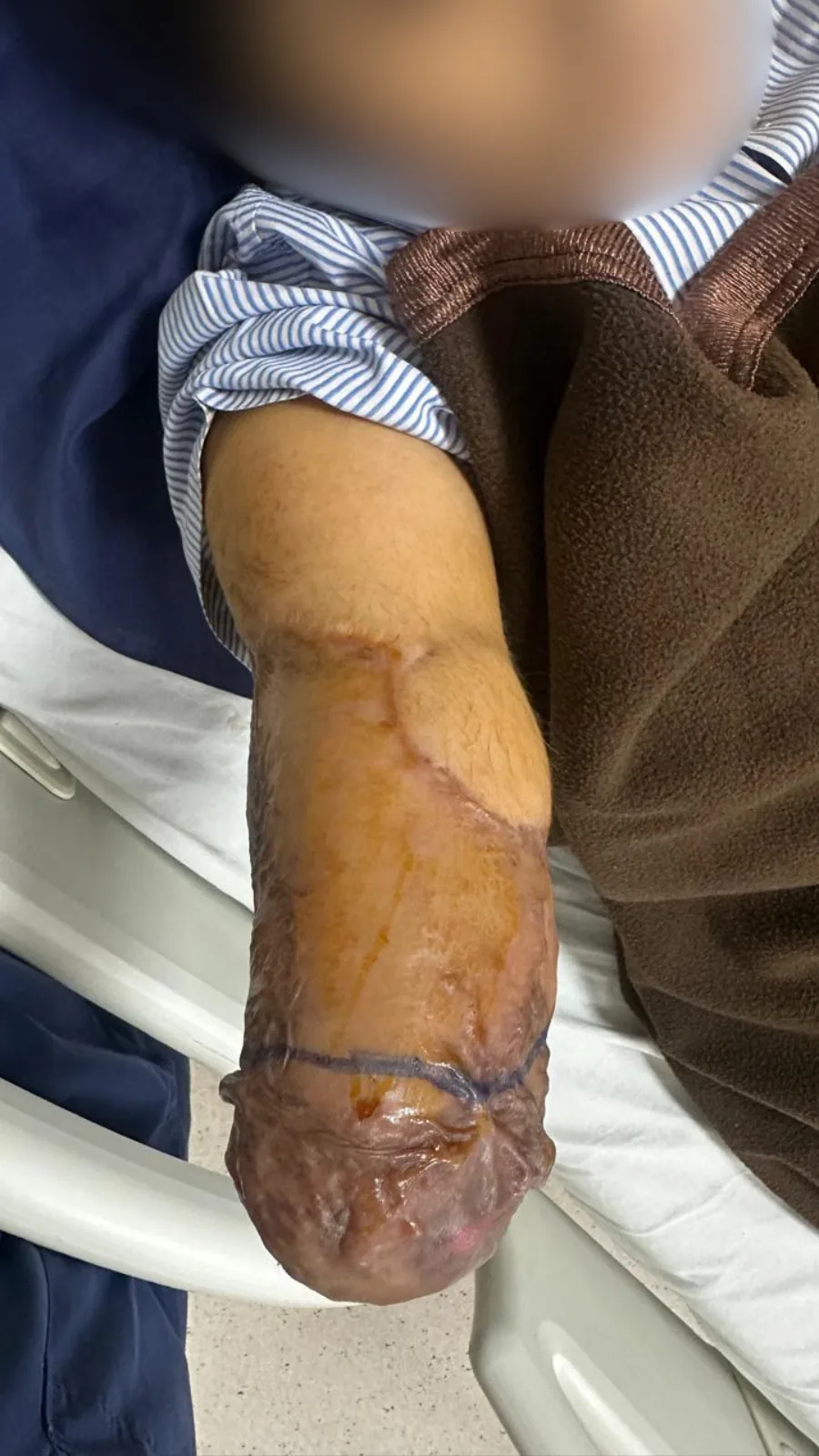 Clinical photograph documenting a residual upper limb at Kiran Hospital, Surat