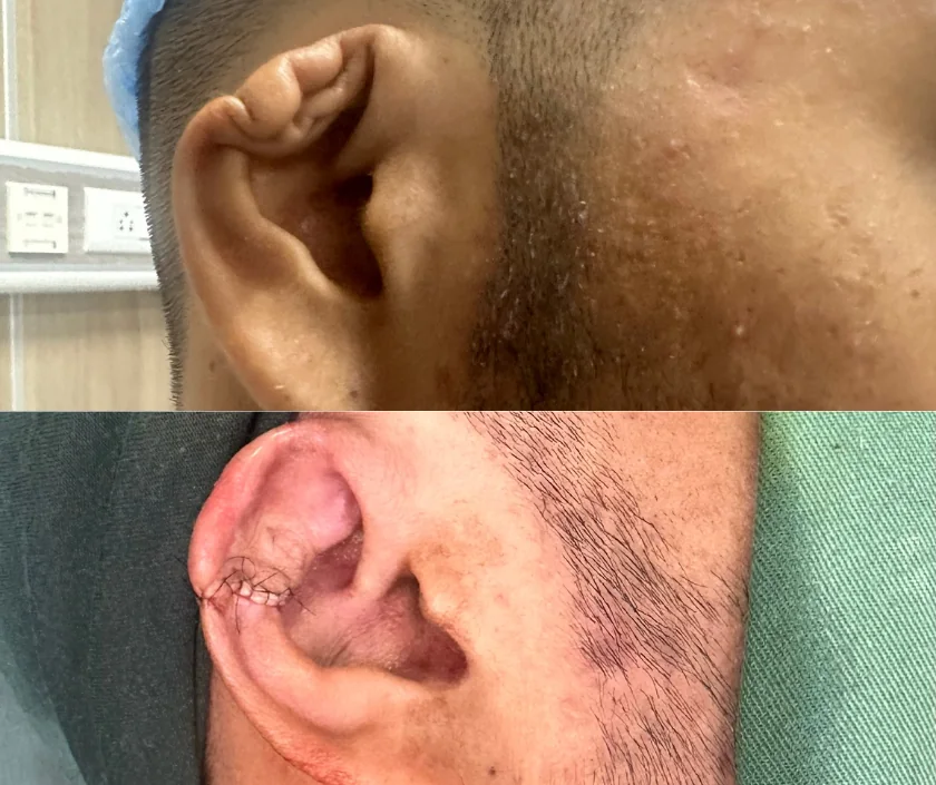 Ear reconstruction surgery in Surat